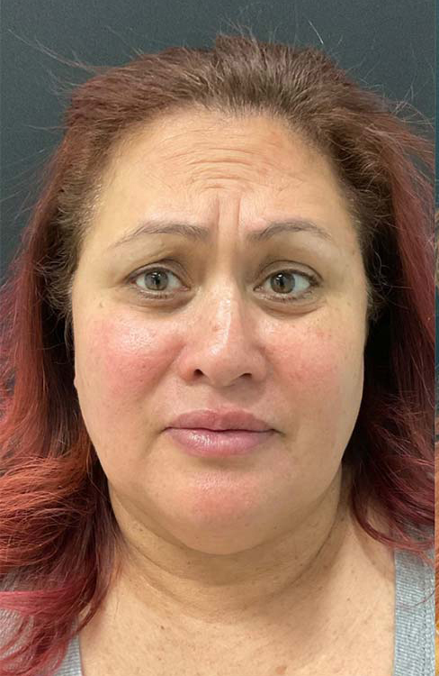 Botox, Dysport, & Xeomin Before & After Patient #10963