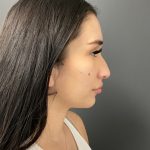 Non-surgical Nose Job Before & After Patient #10967