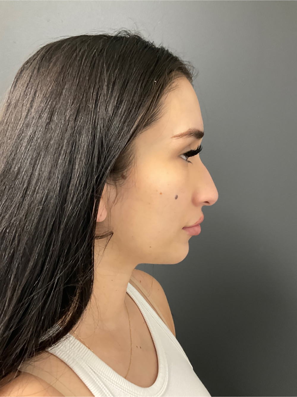 Non-surgical Nose Job Before & After Patient #10967