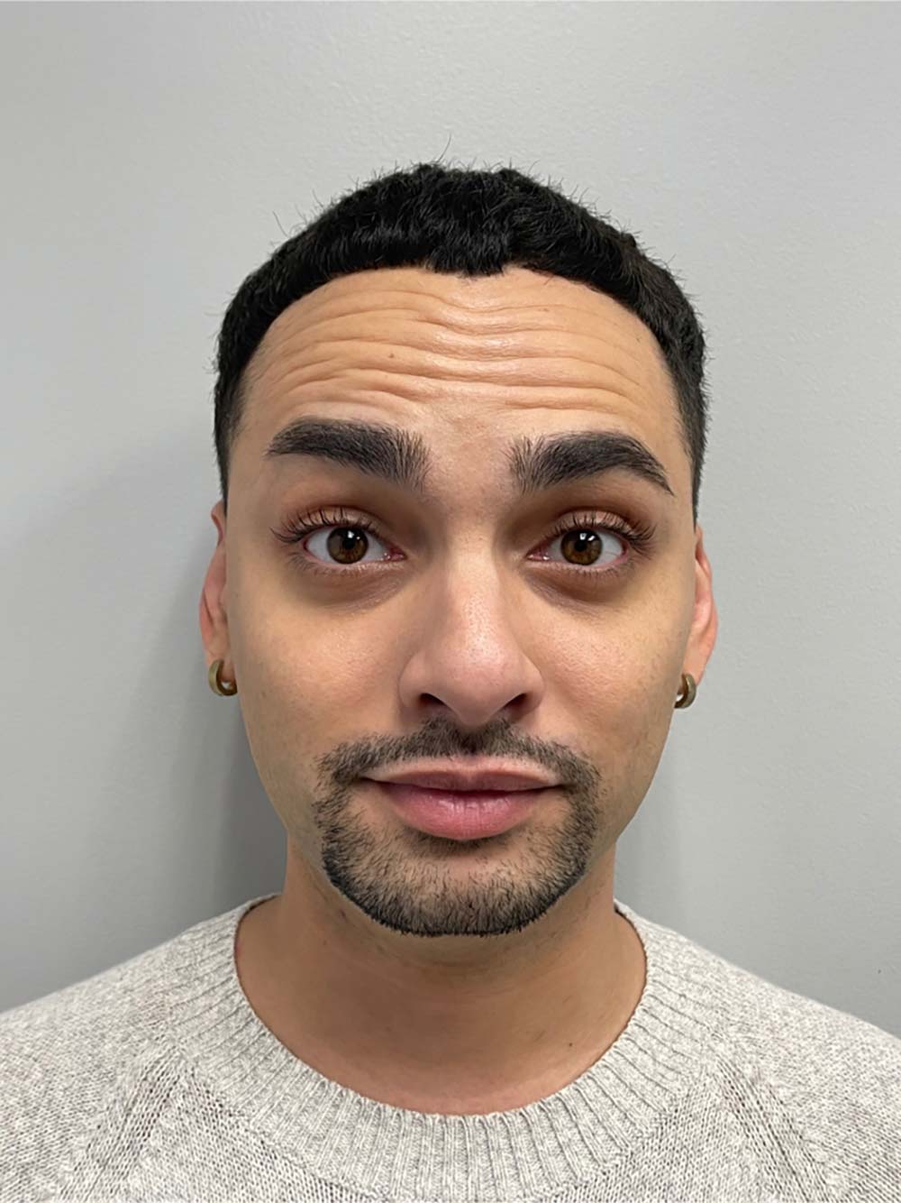 Botox, Dysport, & Xeomin Before & After Patient #10961