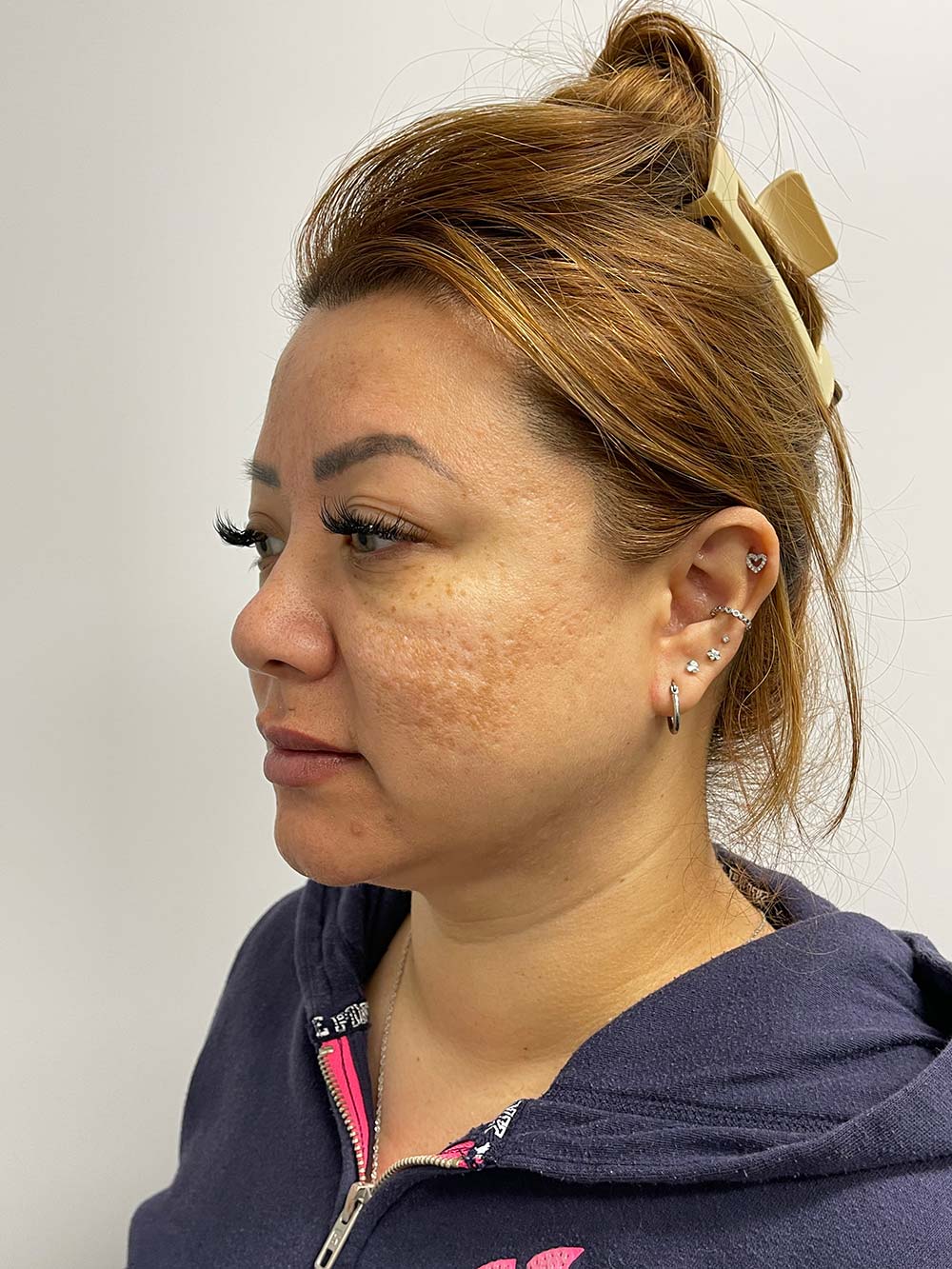 Thread Lift Before & After Patient #11067