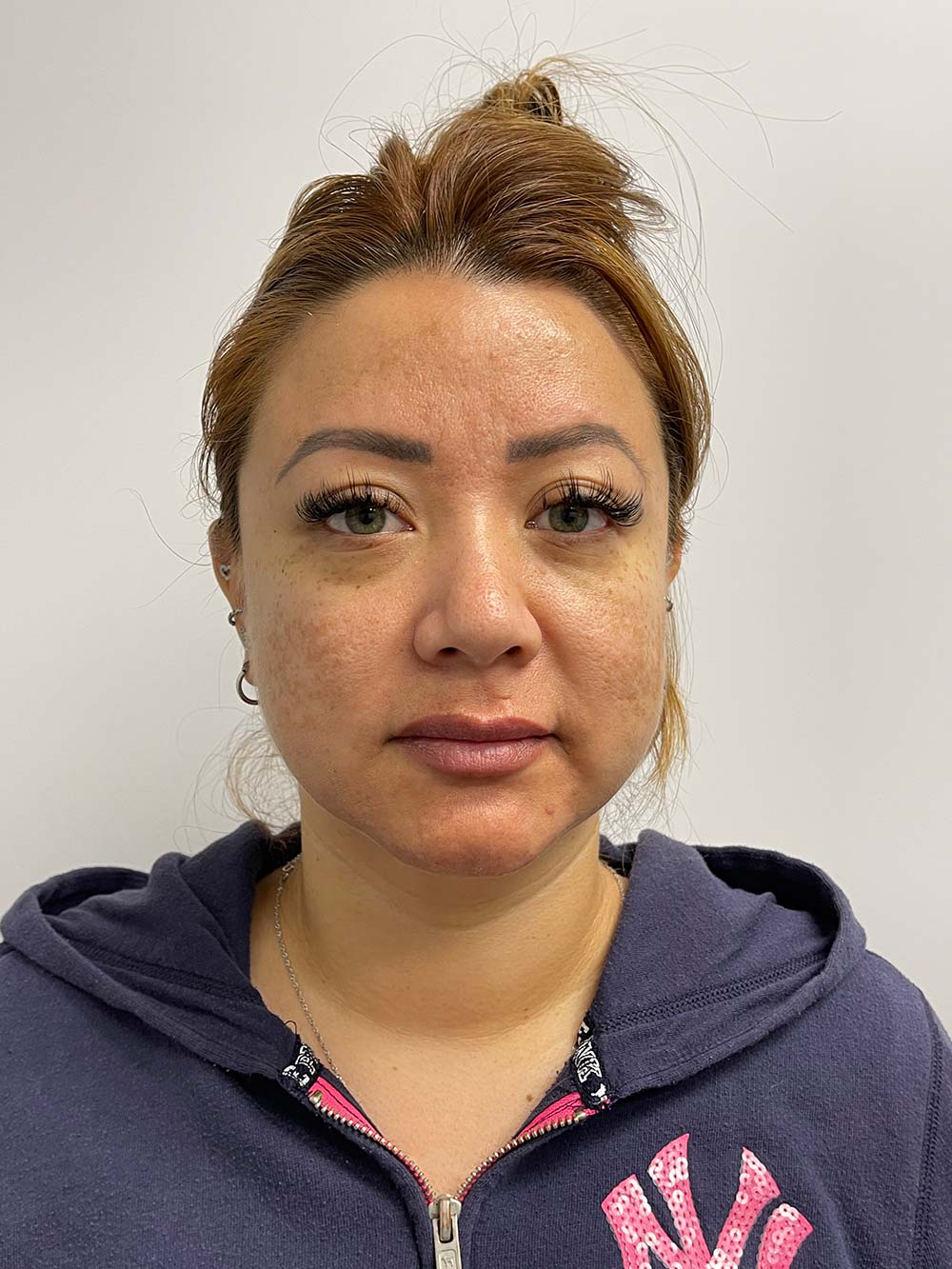 Thread Lift Before & After Patient #11066