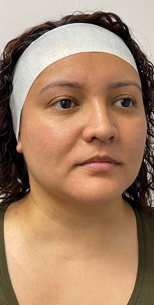 Thread Lift Before & After Patient #11065