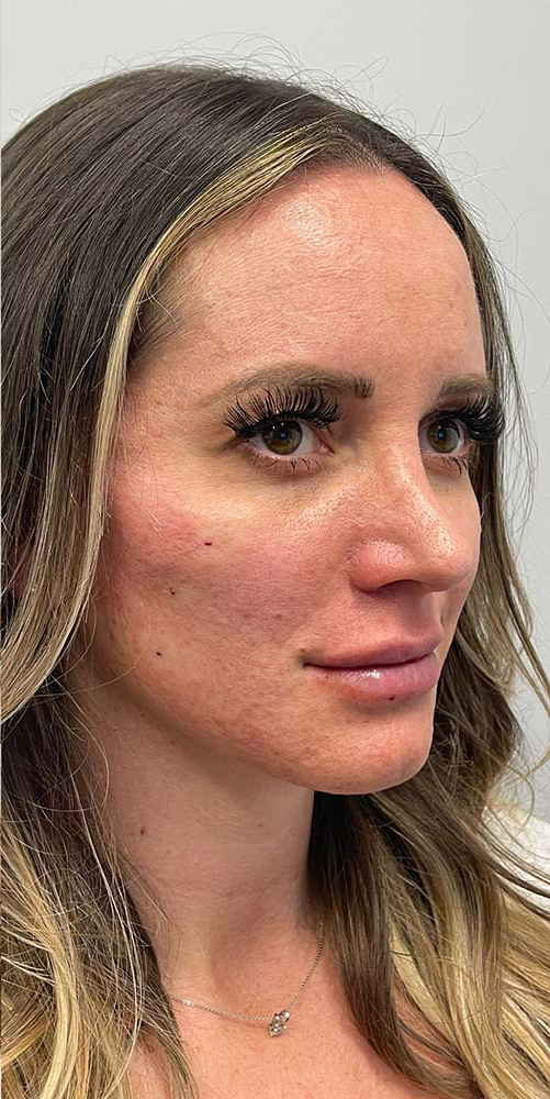 Thread Lift Before & After Patient #11064