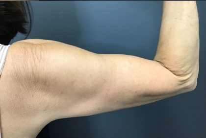 CoolSculpting Before & After Patient #10929