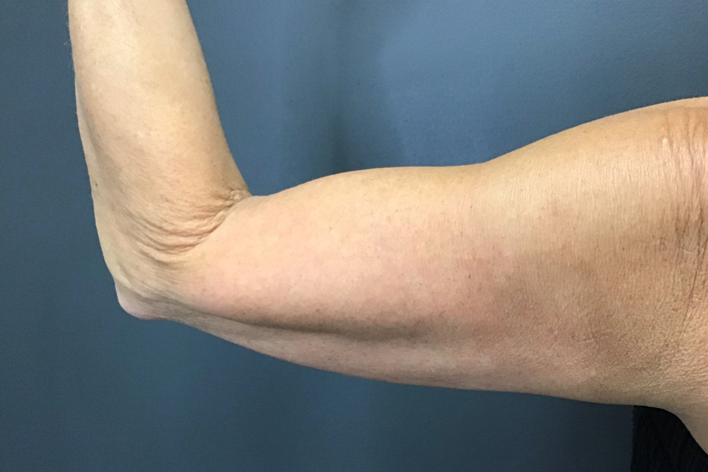 CoolSculpting Before & After Patient #10930