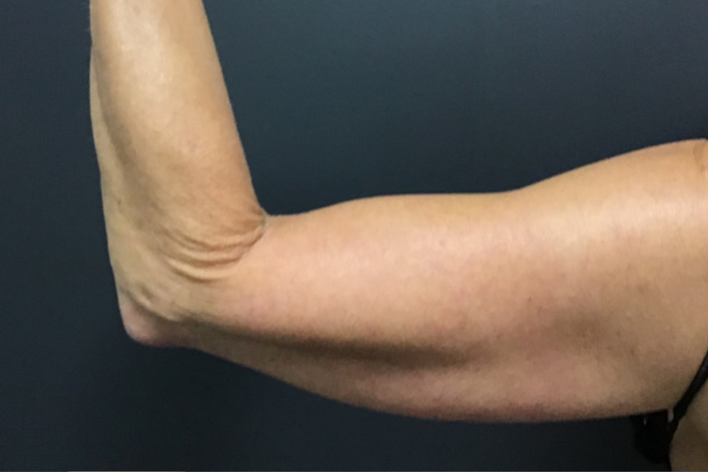 CoolSculpting Before & After Patient #10930