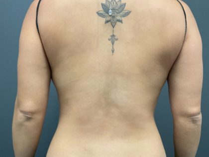 CoolSculpting Before & After Patient #10927