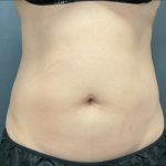 CoolSculpting Before & After Patient #10928