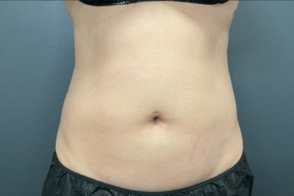 CoolSculpting Before & After Patient #10928