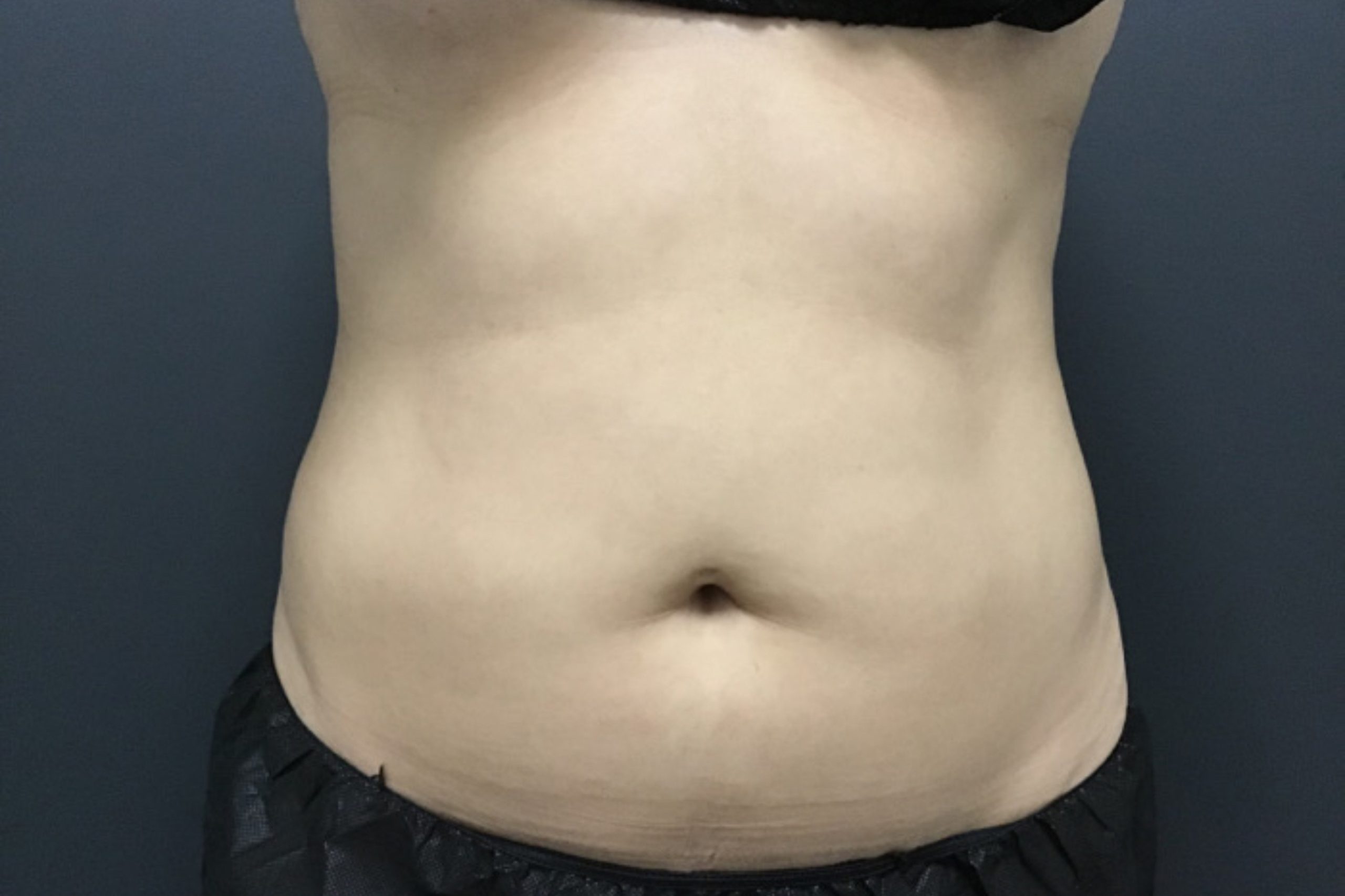 CoolSculpting Before & After Patient #10928