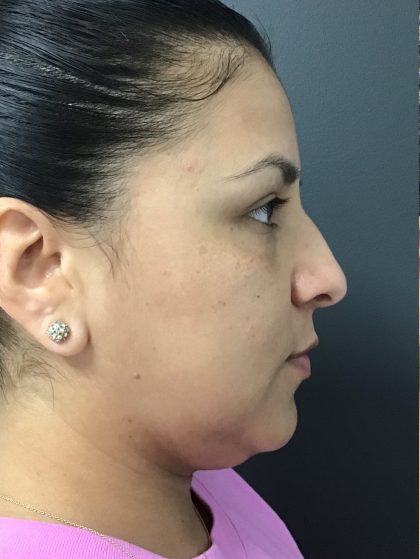 CoolSculpting Before & After Patient #10931