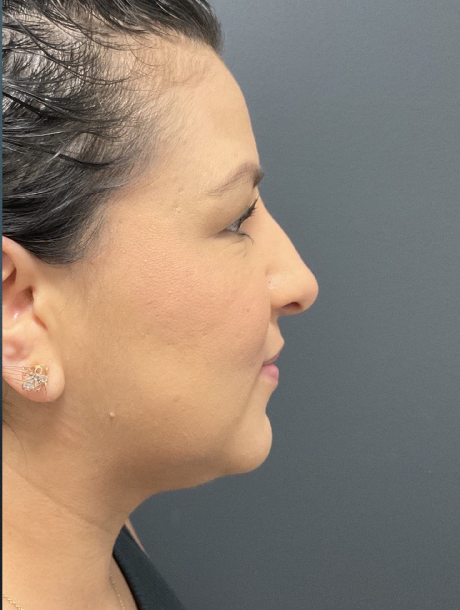 CoolSculpting Before & After Patient #10931