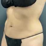 CoolSculpting Before & After Patient #10932