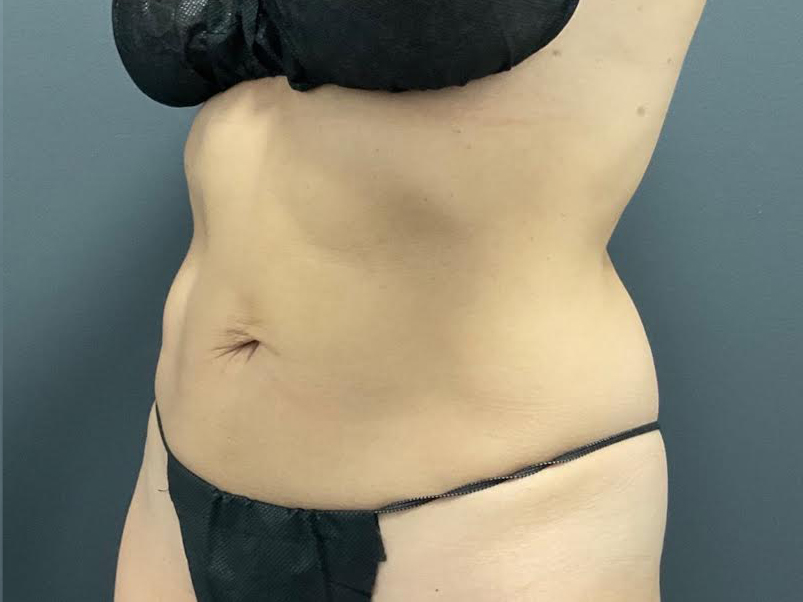 CoolSculpting Before & After Patient #10932