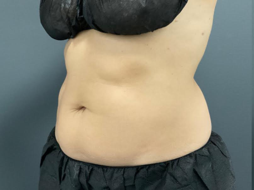 CoolSculpting Before & After Patient #10932