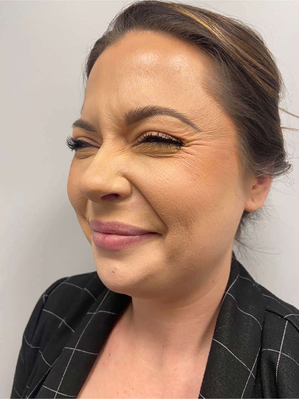 Botox, Dysport, & Xeomin Before & After Patient #10965