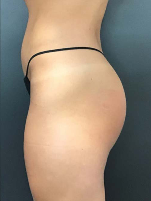 EMSculpt Neo Before & After Patient #10934