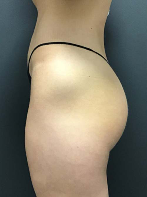 EMSculpt Neo Before & After Patient #10934