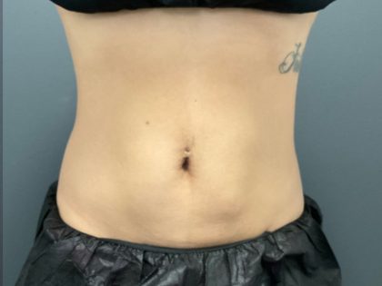 CoolSculpting Before & After Patient #10933