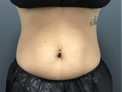 CoolSculpting Before & After Patient #10933