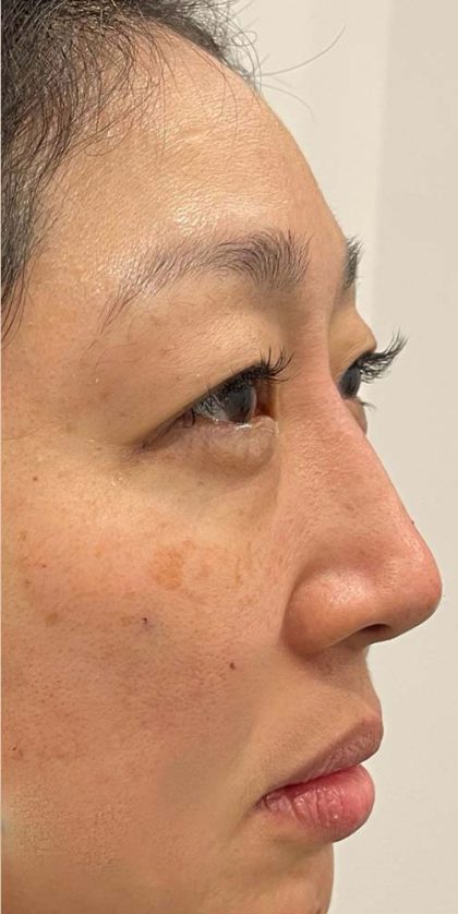 Non-surgical Nose Job Before & After Patient #10972