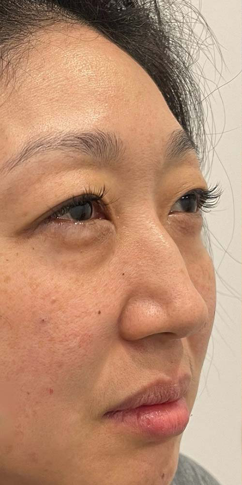 Non-surgical Nose Job Before & After Patient #10972