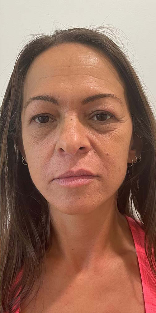 Thread Lift Before & After Patient #11062