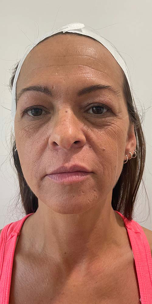 Thread Lift Before & After Patient #11062