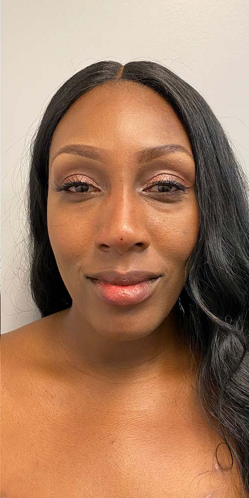 Nose Thread Before & After Patient #11063
