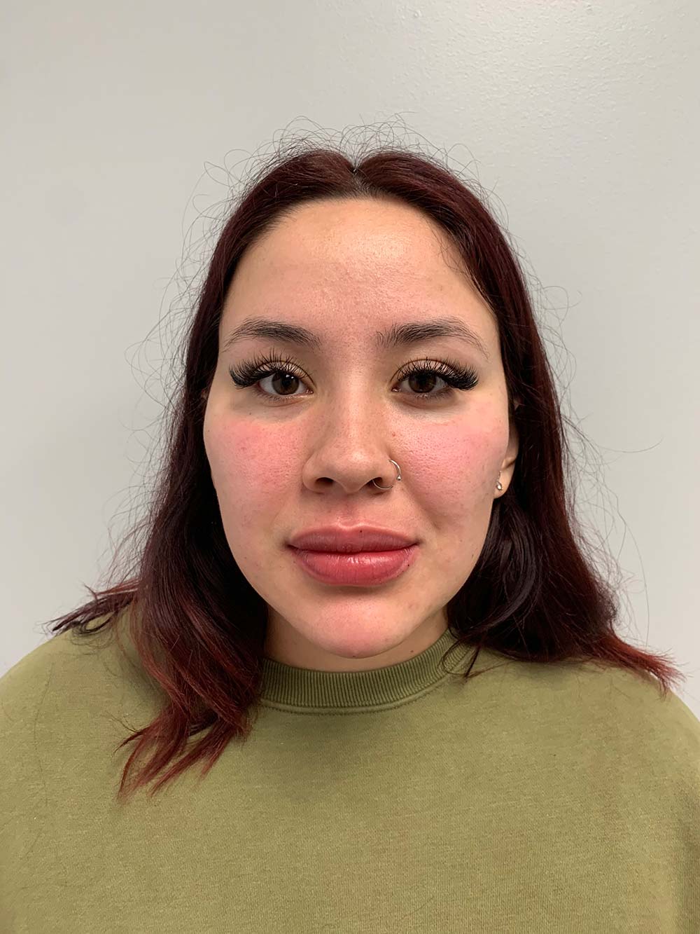 Restylane Before & After Patient #11017