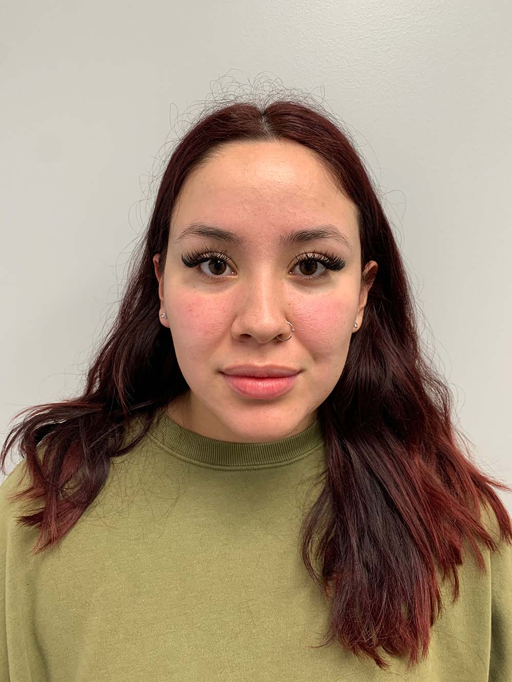 Restylane Before & After Patient #11017