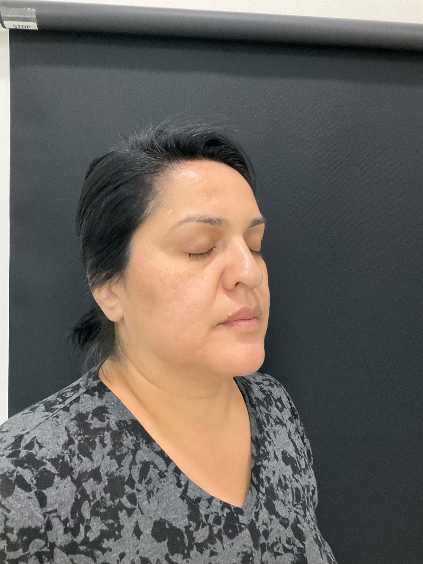 Microneedling Before & After Patient #11027
