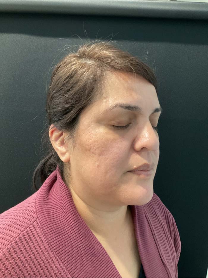 Microneedling Before & After Patient #11027