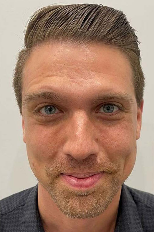 Botox, Dysport, & Xeomin Before & After Patient #10964