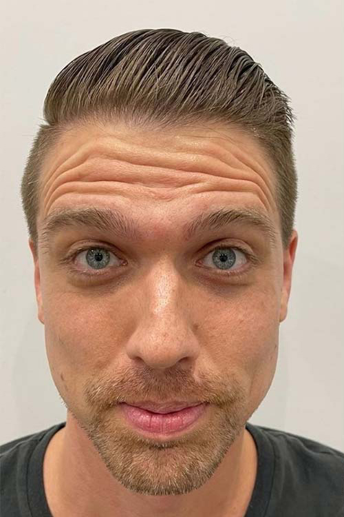 Botox, Dysport, & Xeomin Before & After Patient #10964