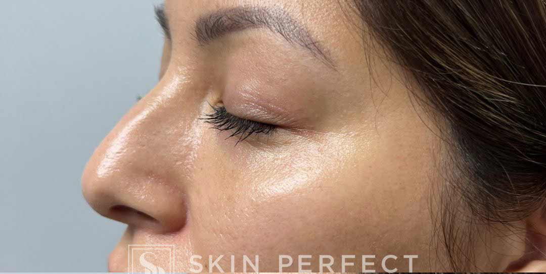 Nose Thread Before & After Patient #11321