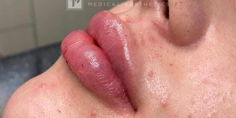 Botox, Dysport, & Xeomin Before & After Patient #11325