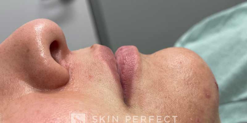Botox, Dysport, & Xeomin Before & After Patient #11329