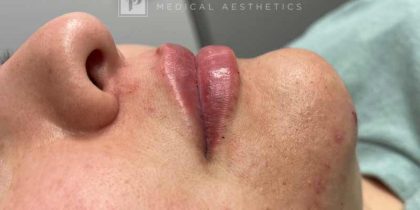 Botox, Dysport, & Xeomin Before & After Patient #11331