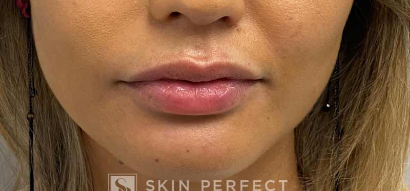Botox, Dysport, & Xeomin Before & After Patient #11332