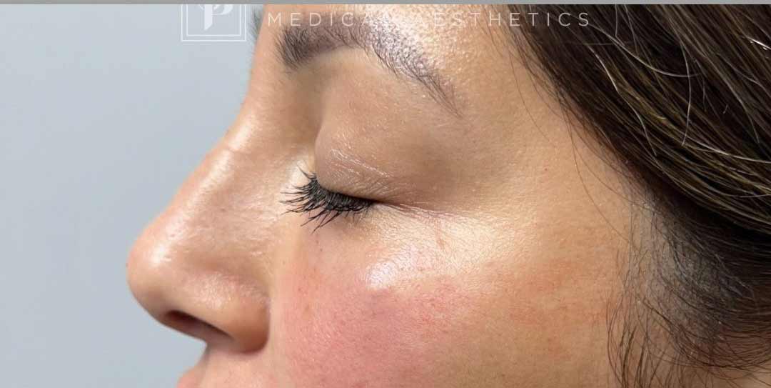 Nose Thread Before & After Patient #11321