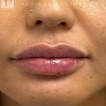 Botox, Dysport, & Xeomin Before & After Patient #11332