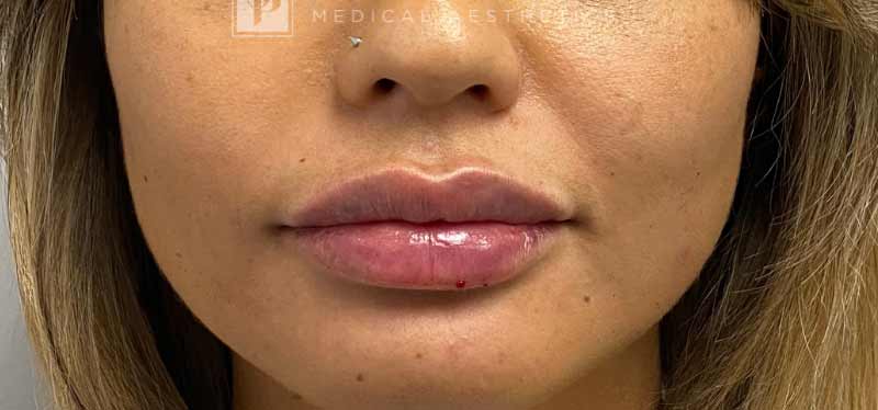 Botox, Dysport, & Xeomin Before & After Patient #11332