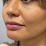 Botox, Dysport, & Xeomin Before & After Patient #11332