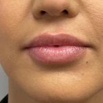 Botox, Dysport, & Xeomin Before & After Patient #11335