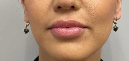 Botox, Dysport, & Xeomin Before & After Patient #11335