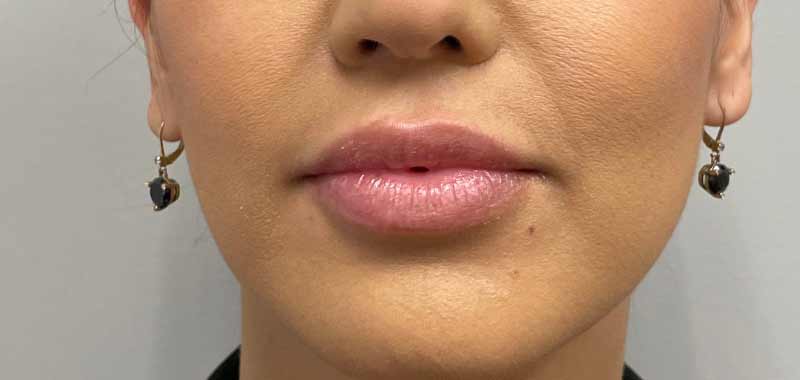 Botox, Dysport, & Xeomin Before & After Patient #11335