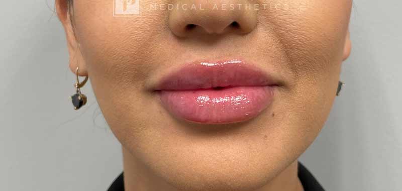 Botox, Dysport, & Xeomin Before & After Patient #11335
