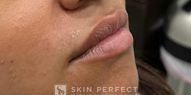 Botox, Dysport, & Xeomin Before & After Patient #11322